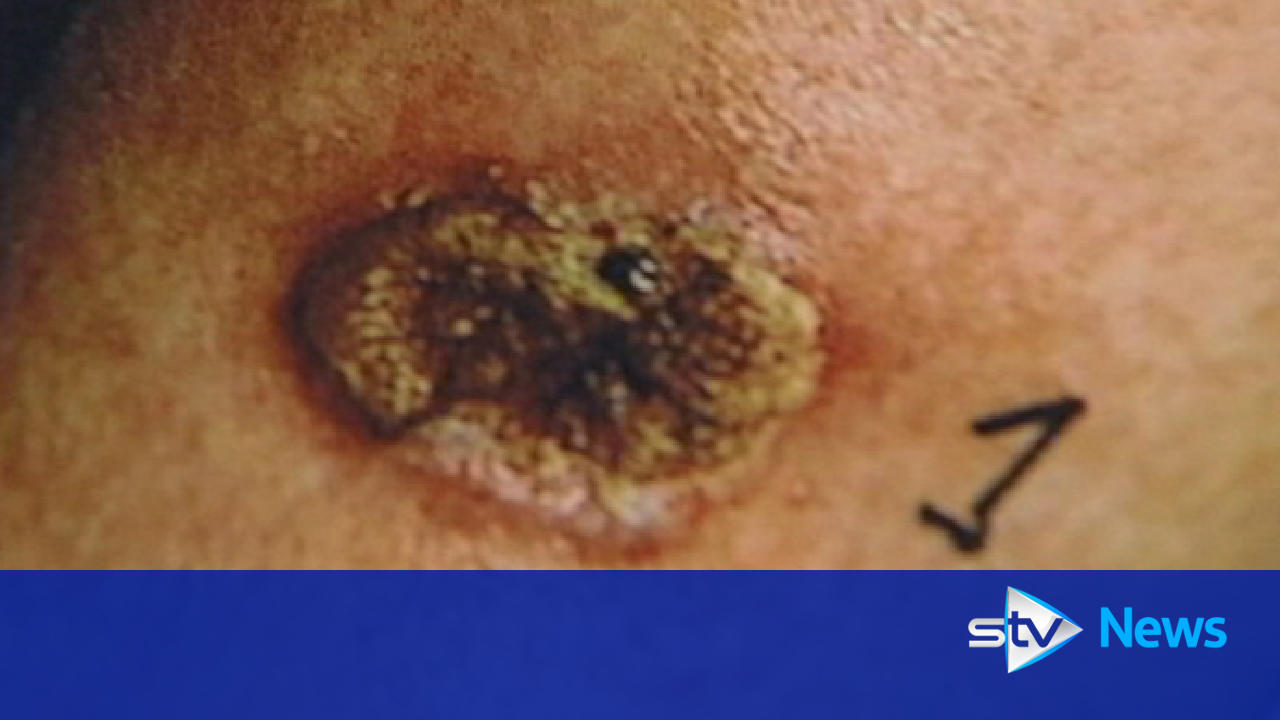 Vast majority of Scots diagnosed with malignant melanoma now survive