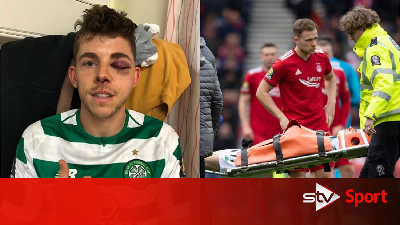 Ryan Christie to undergo surgery for facial fractures