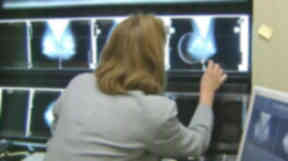 Breast screening: Government has announced review.