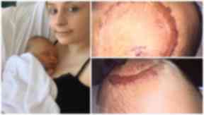 Scarred: Kayden with mother Jessica Henderson.