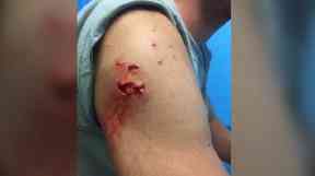 Charlie Fry escaped with nasty bite marks but his body in tact.