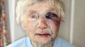 Blanche Rowlands suffered facial injuries and a broken arm when she was assaulted.