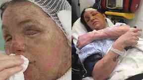 Scarred for life: Teresa Townsley was attacked last year.