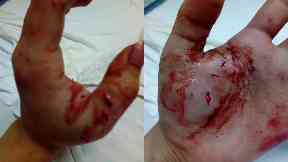 Injuries: Ms Hay fears she won't properly be able to use her hand again.
